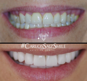 implantes-y-estética-dental