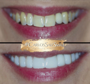 blanqueamiento-dental