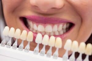 tipos-de-blanqueamiento-dental