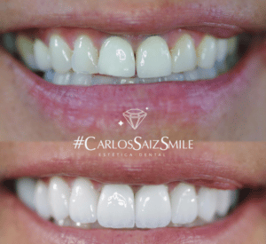 microcarillas dentales