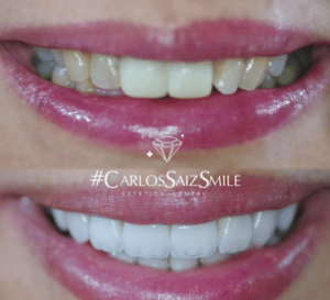 tipos-de-carillas-dentales