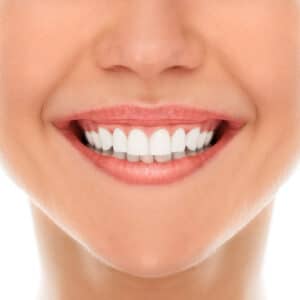 blanqueamiento-dental-con-férulas