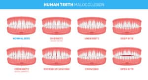 maloclusiones dentales