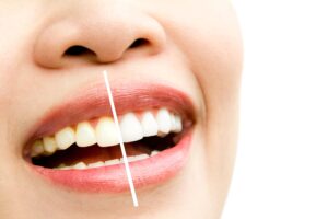 tinciones dentales