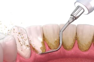 placa dental