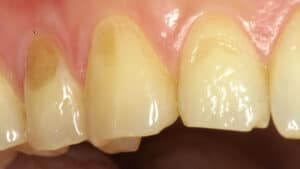 erosión dental