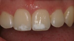 manchas blancas en los dientes