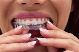 retenedores dentales