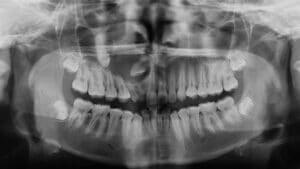 taurodontismo dental