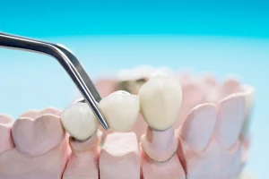 puente dental representación gráfica