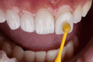 dientes con carillas