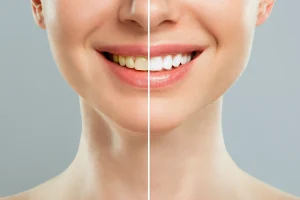 dientes grises antes y después