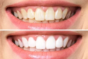 tener dientes blancos, comparativa antes y despues