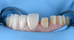 comparativa dientes desgastados y carillas