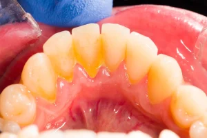 sarro en los dientes