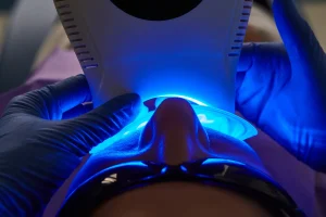 blanqueamiento dental con láser