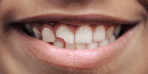 sonrisa con dientes picados