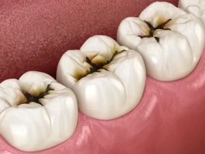 como prevenir la caries