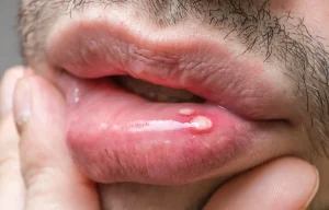 como curar una llaga en la boca en casa