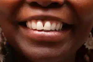 troneras dentales