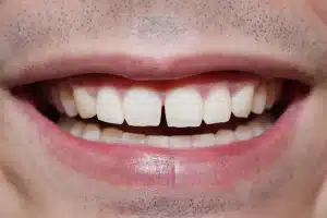 huecos entre los dientes