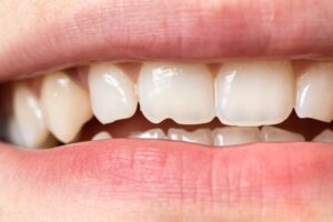 fisura dental en