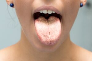 lengua blanca | carlos saiz smile