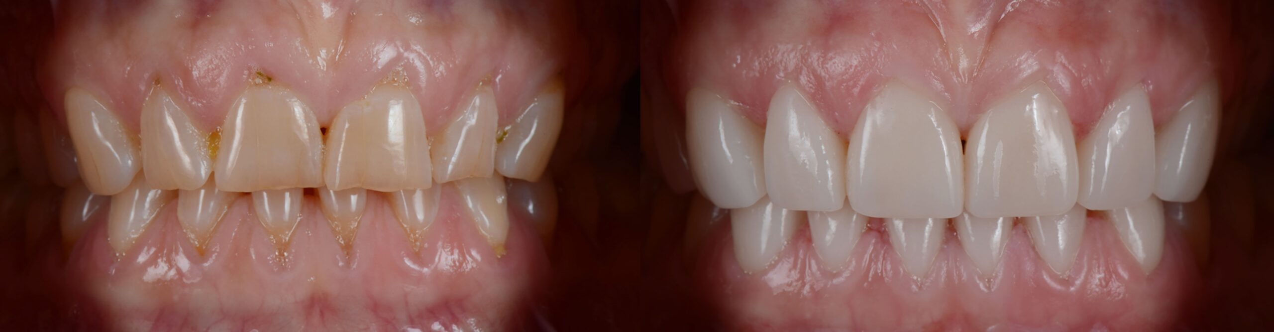 Qué efectos tiene la tetraciclina en los dientes