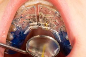 Expansor de paladar