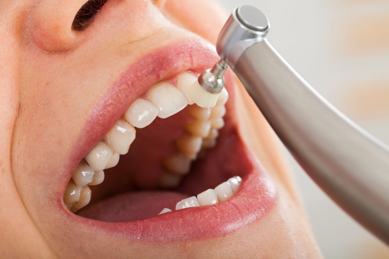 periodoncia | limpiezas dentales profundas