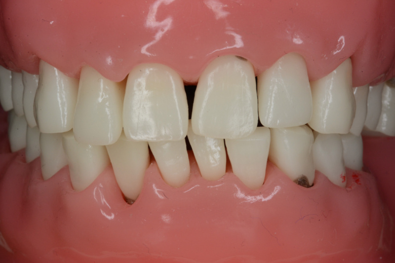 periodontitis: enfermedades periodontales