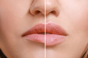 acido hialuronico en labios