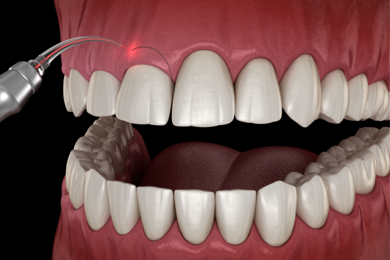 gingivectomy procedure