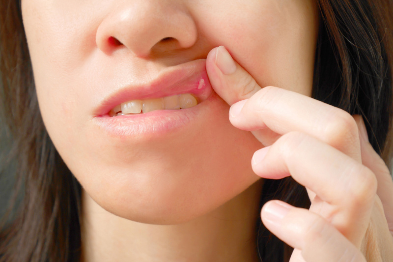 mouth sores