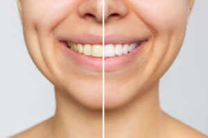 blanqueamiento dental profesional
