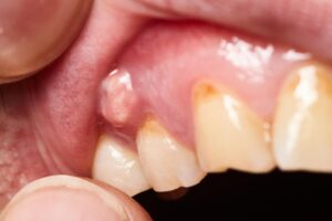 fibroma encía