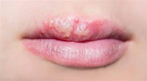 candidiasis oral