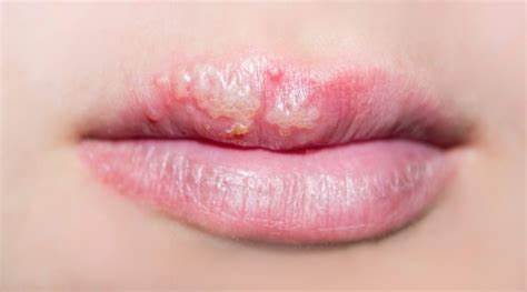 candidiasis oral