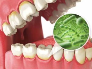 infecciones bucales