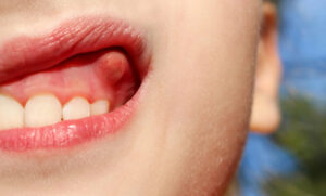absceso dental