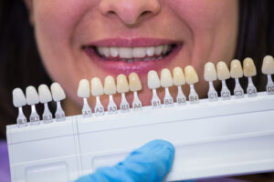 Ventajas de las carillas dentales sin tallado