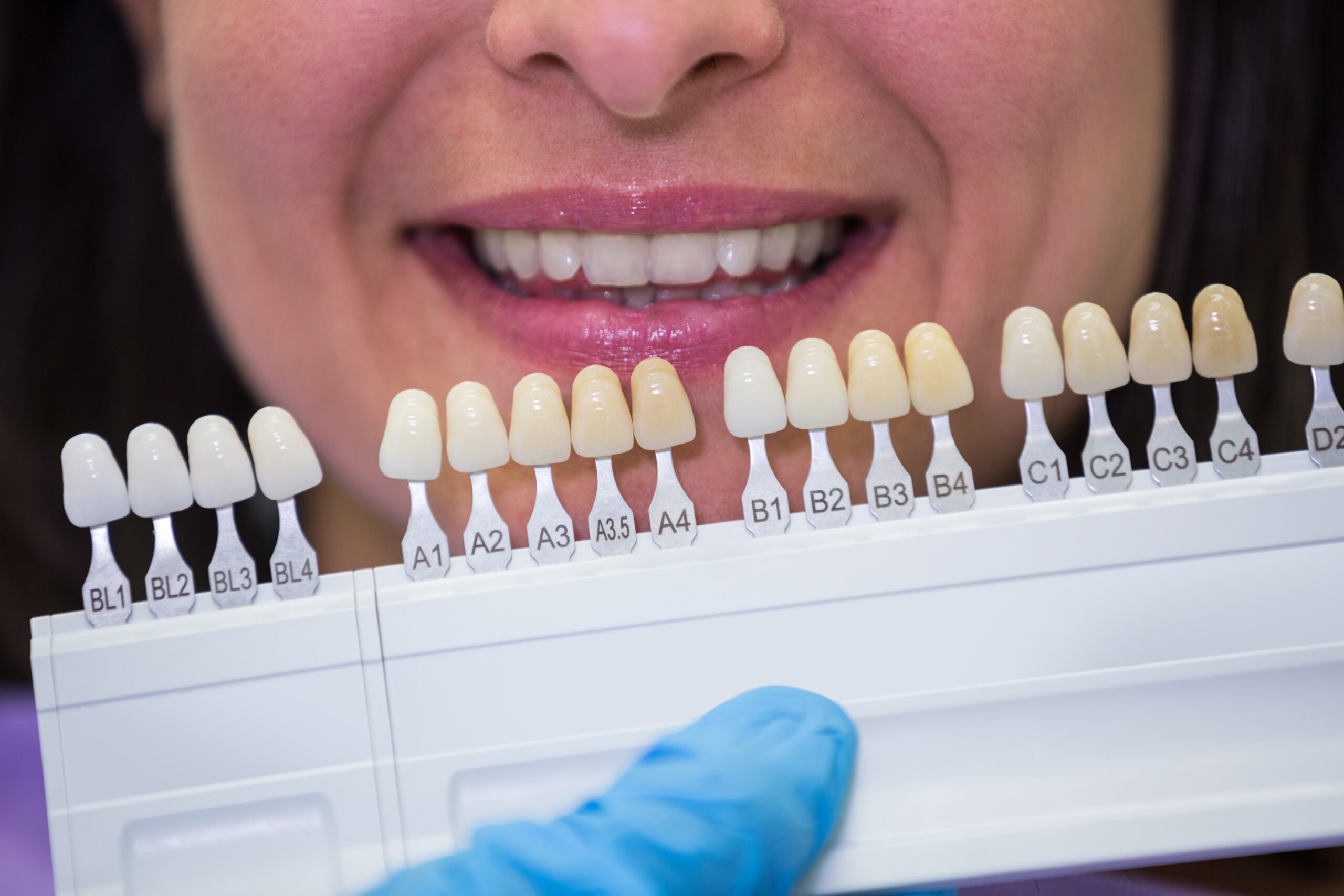 Ventajas de las carillas dentales sin tallado