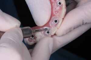 puente dental provisional