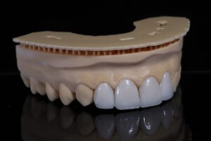 que son las carillas dentales​