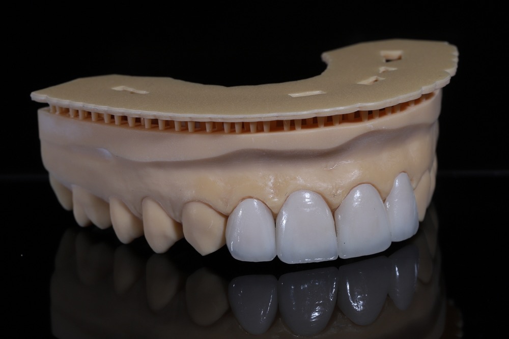 que son las carillas dentales​