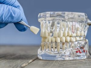 soluciones dentales sin implantes
