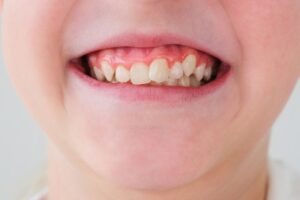 como arreglar dientes apiñados sin ortodoncia