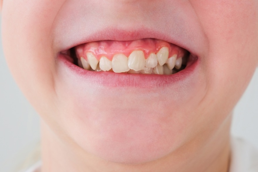 como arreglar dientes apiñados sin ortodoncia