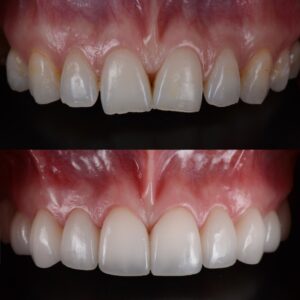 carillas dientes apiñados