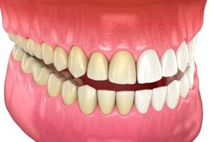 blanqueamiento dental estetico